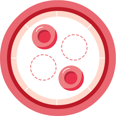 Mangel an roten Blutzellen in der Blutbahn bei aHUS