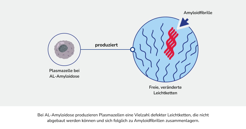 Plasmazelle bei AL-Amyloidose, die defekte Leichtketten produziert, welche sich zu Amyloidfibrillen zusammenlagern