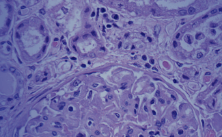 Lila eingefärbte Amyloidablagerungen unter einem Mikroskop