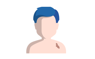 Mit brauner Pigmentstörung