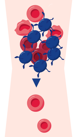Trombophilie: Blutkörperchen und Blutplättchen bilden ein Blutgerinnsel